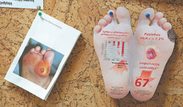 Stenduose – cukrinio diabeto komplikacijų rezultatai.